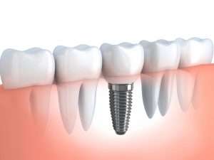 dental implants richmond nsw tooth implants