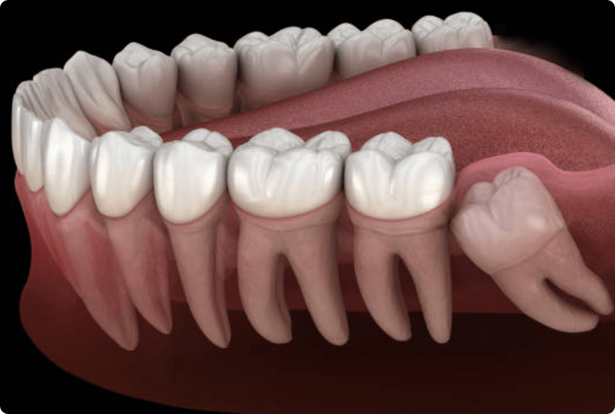 DentEssential Wisdom Teeth Removal Richmond
