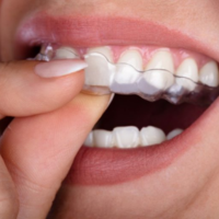 General Dentistry The Benefits of Invisalign A Convenient and Discreet Alternative to Braces